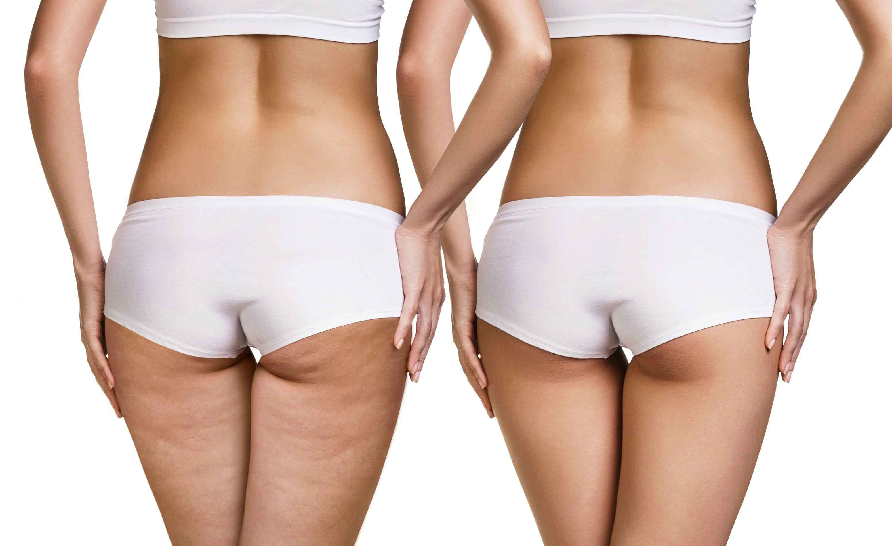 Combattere la cellulite si può