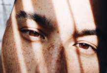 MACCHIE SOLARI | Prevenirle è meglio che curarle, ma oggi si possono anche rimuovere Macchie solari