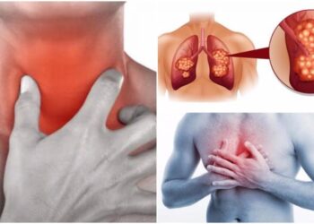 Carcinoma polmonare causa 34mila morti in Italia ogni anno
