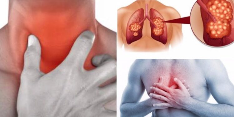 Carcinoma polmonare causa 34mila morti in Italia ogni anno