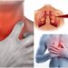 Carcinoma polmonare causa 34mila morti in Italia ogni anno