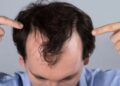 Caduta dei capelli