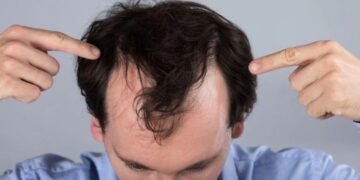 Caduta dei capelli