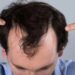 Caduta dei capelli